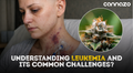 CBD Oil for Leukemia Symptoms and Side Effects: Can It Help?