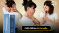 CBD Oil for Urticaria: Benefits, Dosage &amp; How to Use It