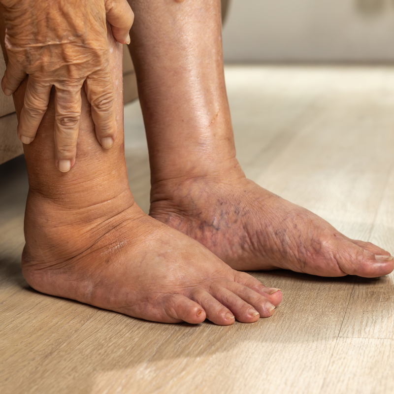 Swelling Management