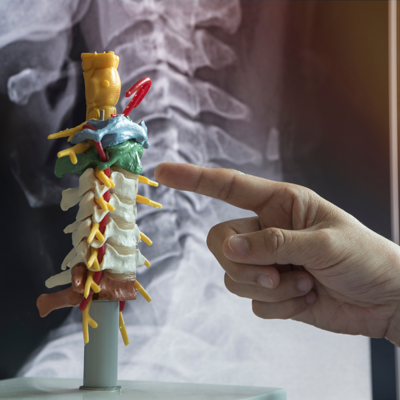Cervical Spondylosis