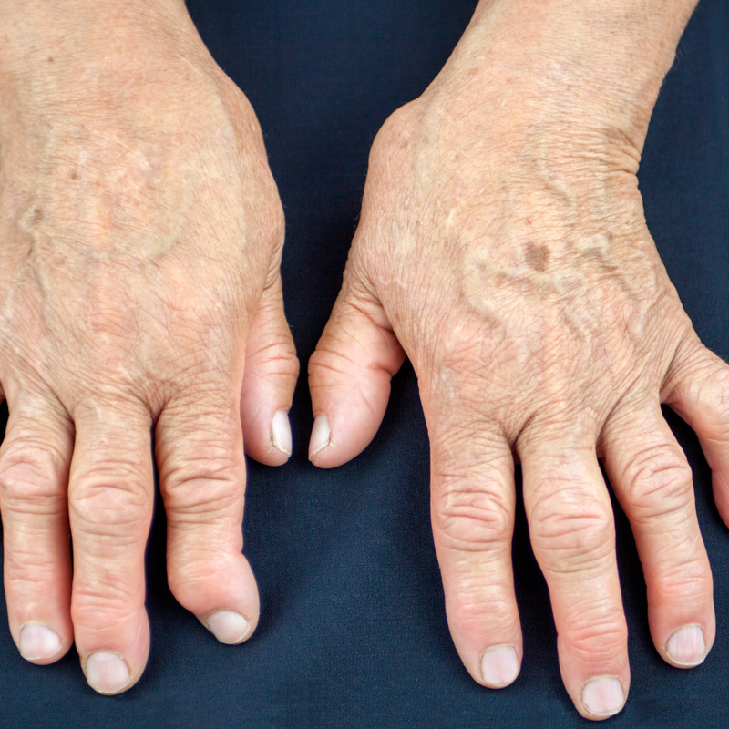 Osteoarthritis