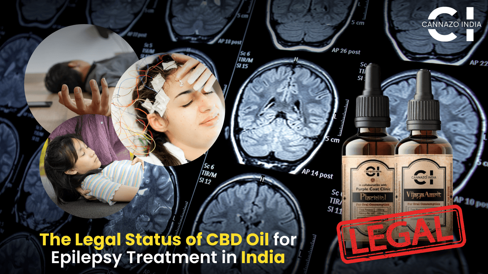 CBD Oil for Epilepsy