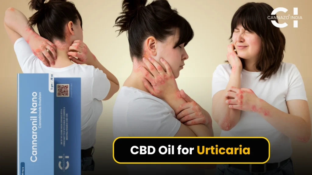 CBD Oil for Urticaria